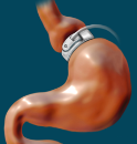 230px-adjustable_gastric_band